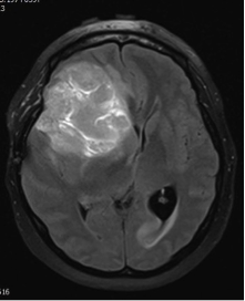 Снимки мрт головного мозга больного человека thumbnail