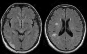Как выглядит мрт головного мозга здорового человека фото и больного thumbnail