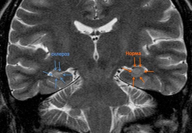 Снимки мрт головного мозга здорового человека фото thumbnail