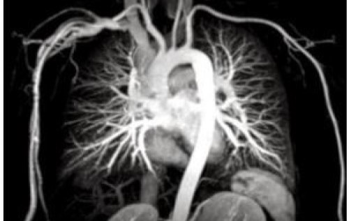 что показывает КТ-ангиография легочных артерий